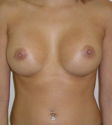 after Breast Augmentation 2
