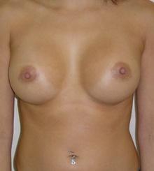 after Breast Augmentation 2