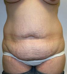 before Tummy Tuck 3