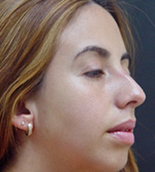 before Rhinoplasty 1