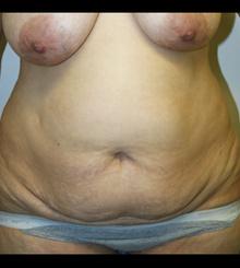 before Tummy Tuck 5
