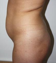 before Brazilian Butt Lift 22