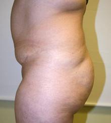 before Brazilian Butt Lift 2