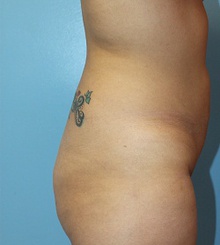 before Brazilian Butt Lift 5