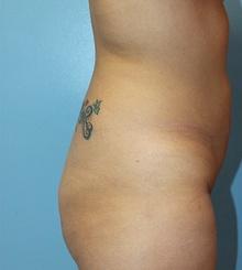 before Brazilian Butt Lift 5