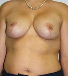 after Breast Lift 27