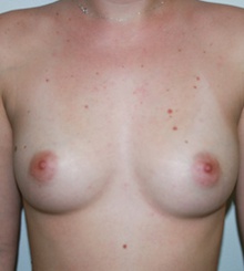 before Breast Augmentation 50