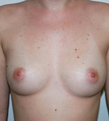 before Breast Augmentation 50