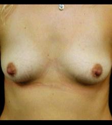 before Breast Augmentation 65