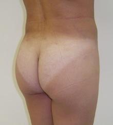 after Brazilian Butt Lift 17