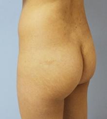 before Brazilian Butt Lift 18