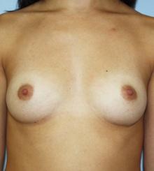 before Breast Augmentation 53