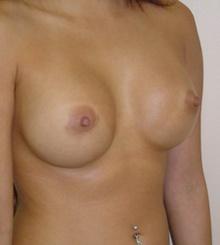 after Breast Augmentation 2