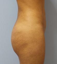 after Body Sculpting 9