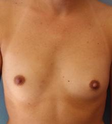 before Breast Augmentation 58