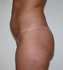 before Brazilian Butt Lift 7