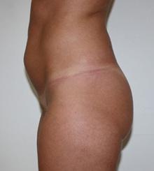 before Brazilian Butt Lift 7