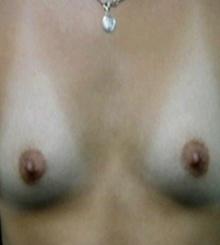 before Breast Augmentation 19