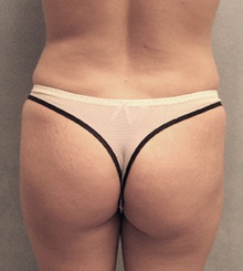 before Brazilian Butt Lift 23