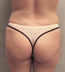 before Brazilian Butt Lift 23