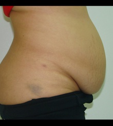 before Tummy Tuck 12