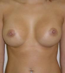 after Breast Augmentation 29