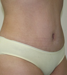 after Tummy Tuck 11