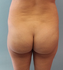 before Brazilian Butt Lift 20