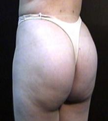 after Brazilian Butt Lift 3