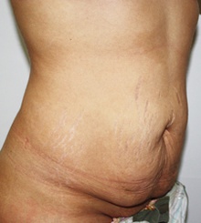 before Tummy Tuck 4