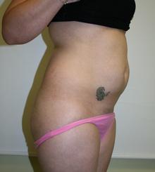 after Brazilian Butt Lift 1