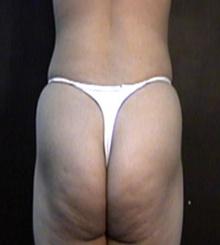 before Brazilian Butt Lift 27