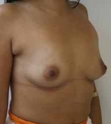 before Breast Augmentation 18