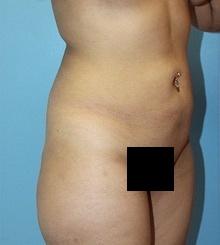 before Body Sculpting 1
