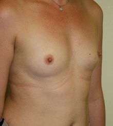 before Breast Augmentation 13