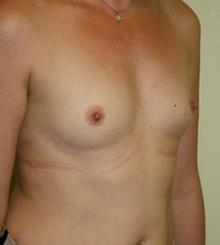 before Breast Augmentation 13