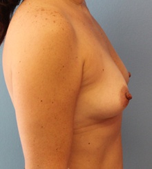 before Breast Augmentation 62