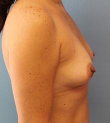 before Breast Augmentation 62