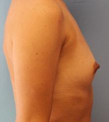 before Breast Augmentation 58
