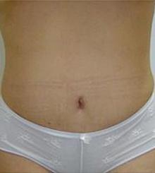 after Tummy Tuck 1