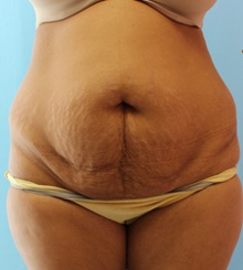 before Tummy Tuck 13