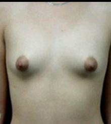 before Breast Augmentation 22