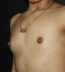 before Breast Augmentation 51