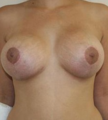 after Breast Lift 6