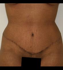 after Tummy Tuck 8