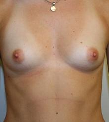 before Breast Augmentation 55