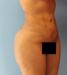 after Body Sculpting 1