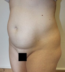before Body Sculpting 11