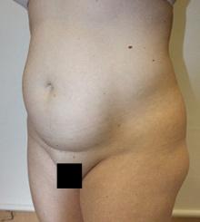 before Body Sculpting 11
