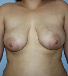 before Breast Lift 35